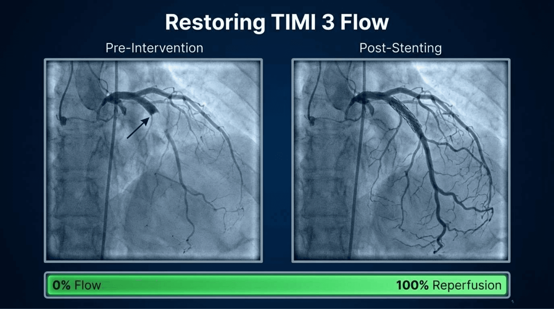 Slide 9 of STEMI: Minutes Mean Myocardium
